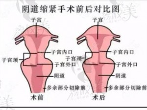 3d 束带紧缩术——安全有效的私密紧致术