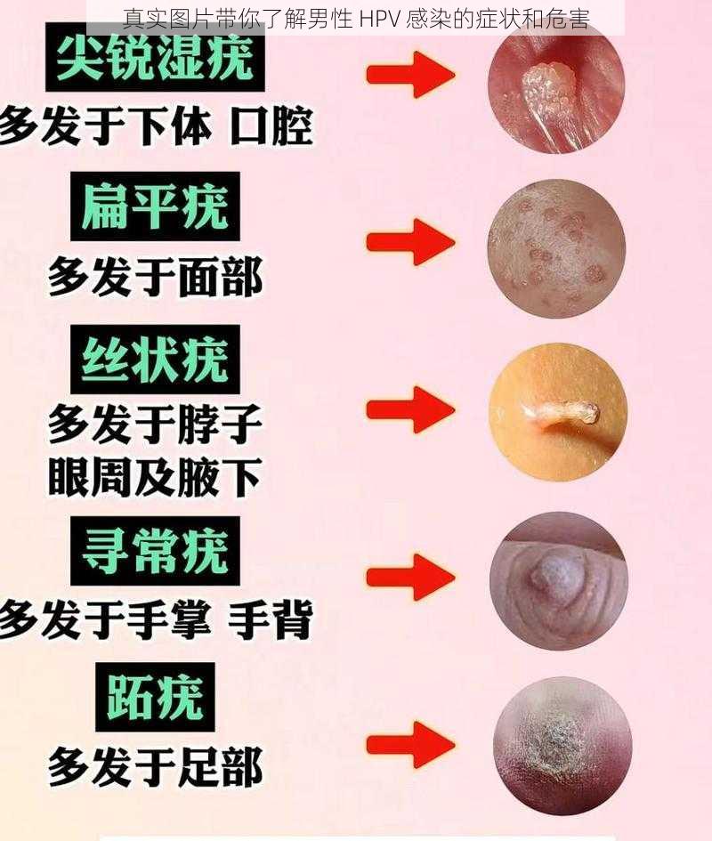 真实图片带你了解男性 HPV 感染的症状和危害