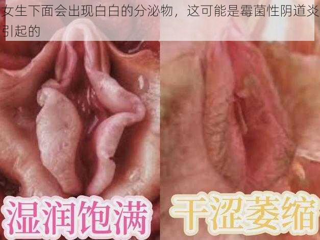 女生下面会出现白白的分泌物，这可能是霉菌性阴道炎引起的